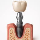 Combien coûte un implant dentaire en France