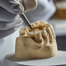 Combien de séances pour un implant dentaire