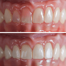 Implant dentaire gencive rétractée