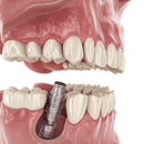 Les inconvénients des implants dentaires