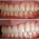 Prix implant dentaire mâchoire complète Hongrie avis