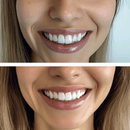 Implants dentaires sans vis